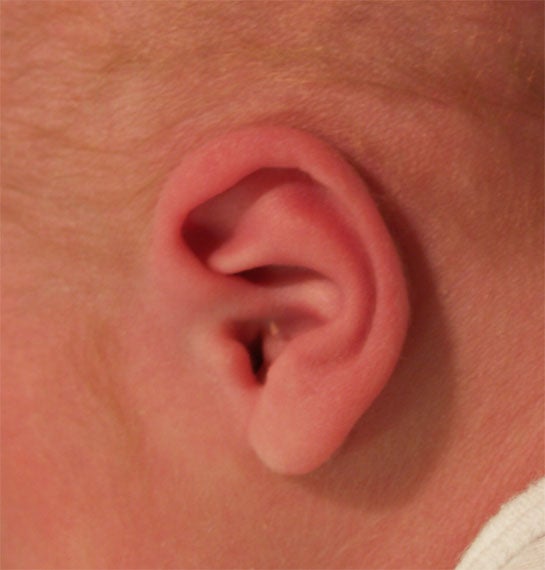 Ear normal-Janelle Aby, MD Stanford University Medical Center.jpg